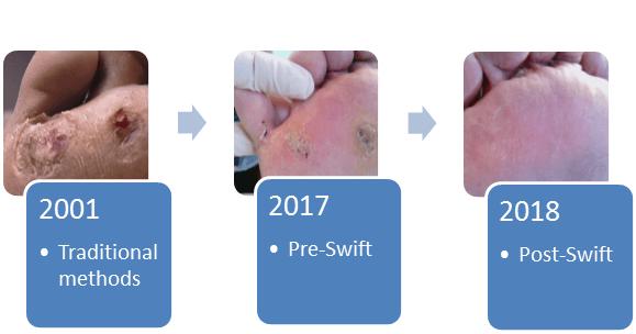 The process of a verruca and SWIFT treatment