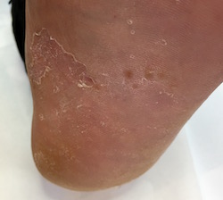 Red peeling sale skin on feet