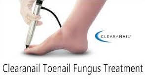 clearnail treatment