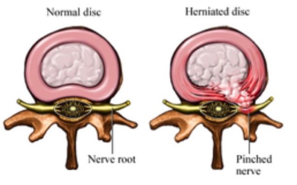 Intervertebral disk pain