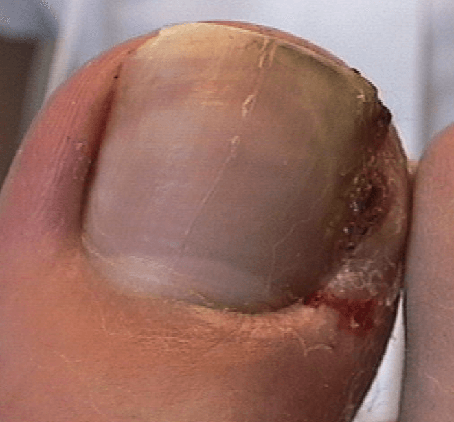 Ingrown Toenail