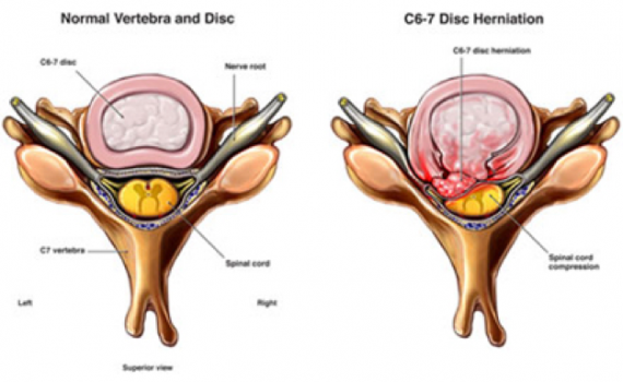 Invertebral Disks