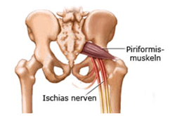 Piriformis Syndrome