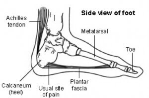 Plantar Fasciitis Treatment