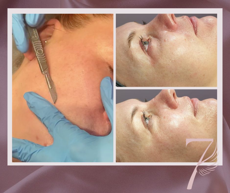 dermaplaning facials