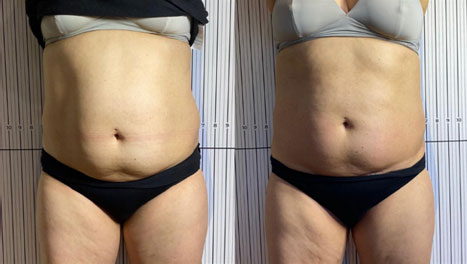 Body contouring results