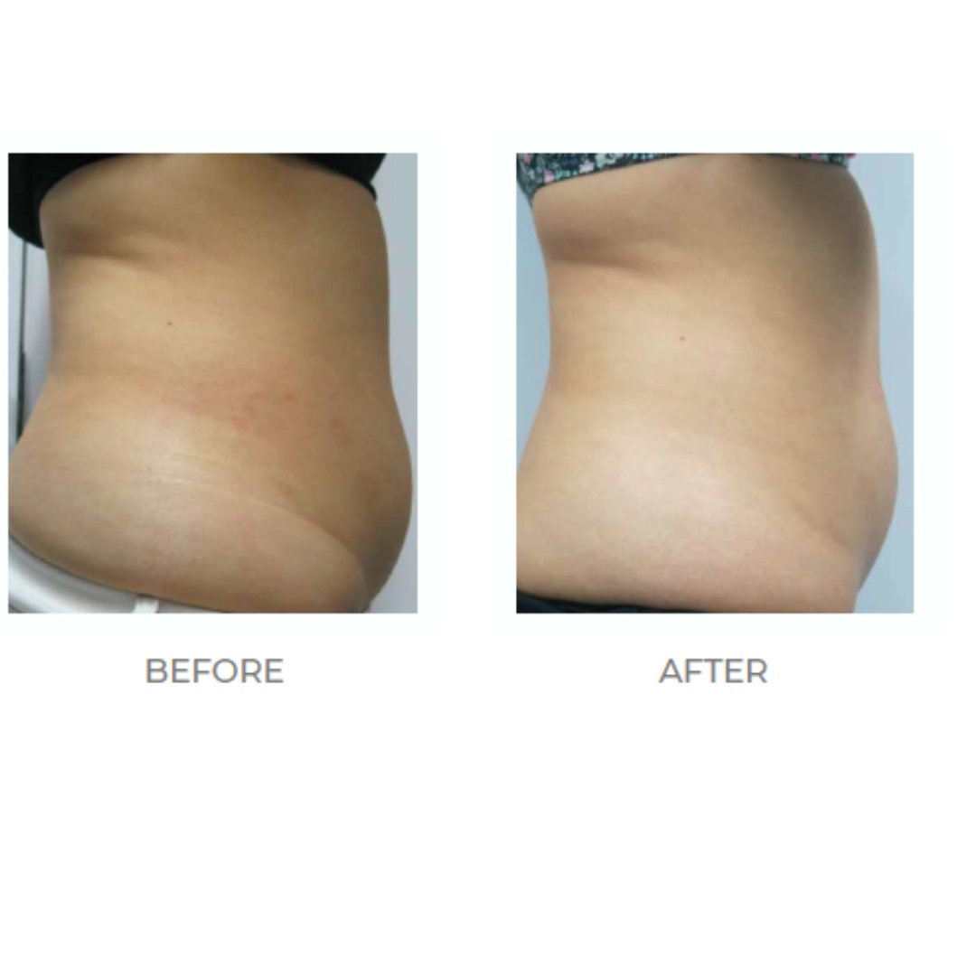 Body contouring results