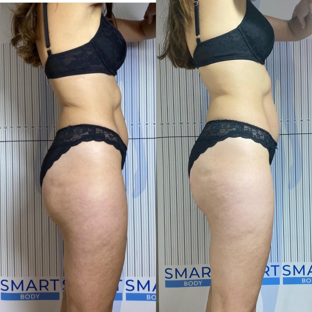 Body contouring results