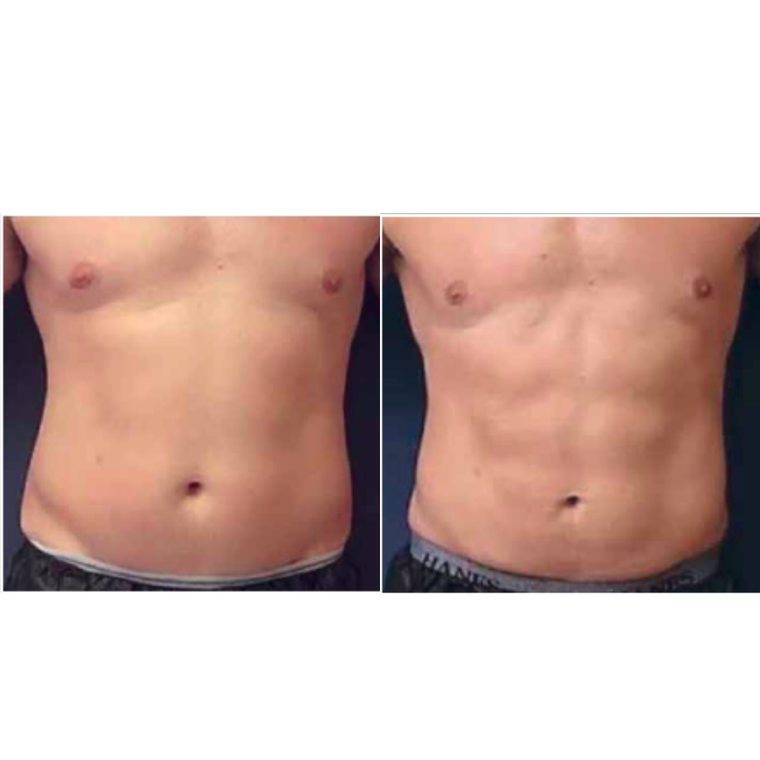 Body contouring results