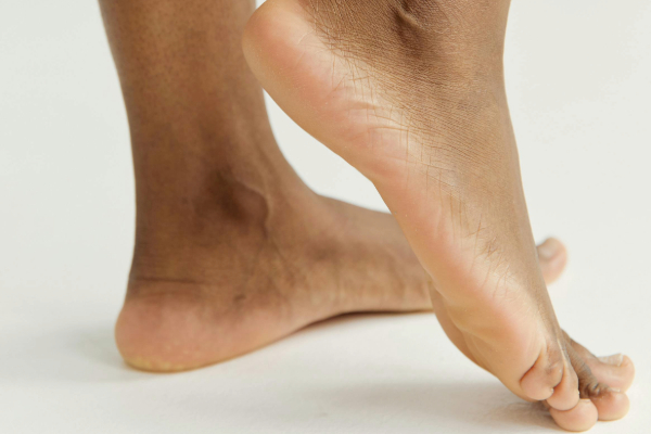What is Morton’s Neuroma and How Can You Treat It?