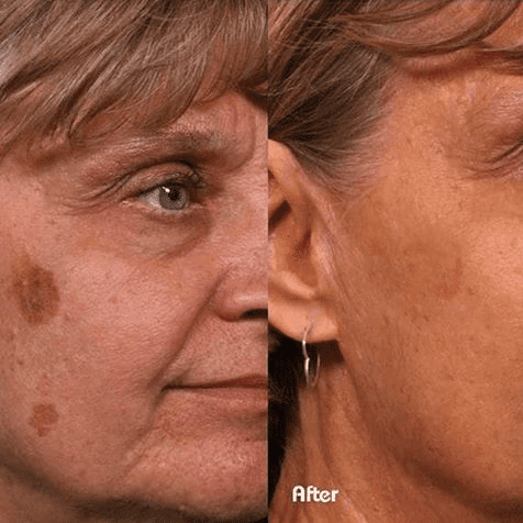 Pigmentation Age Spots Removal Sun Damage Hatfield Beausynergy