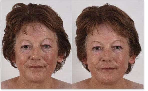 non surgical face lift before and after