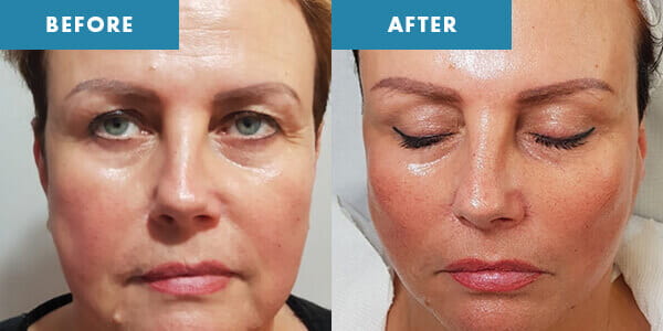 Cryolift before and after