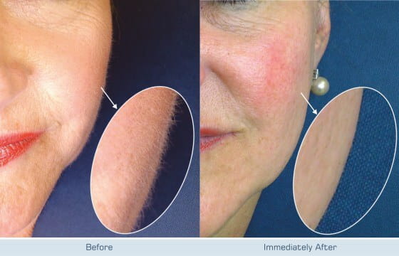 Hair V Go The Future Of Hair Removal At Beausynergy Herfordshire Clinic