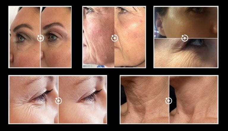 Fibroblast Plasma Pen | ib Pro Plasma | Herts | BeauSynergy