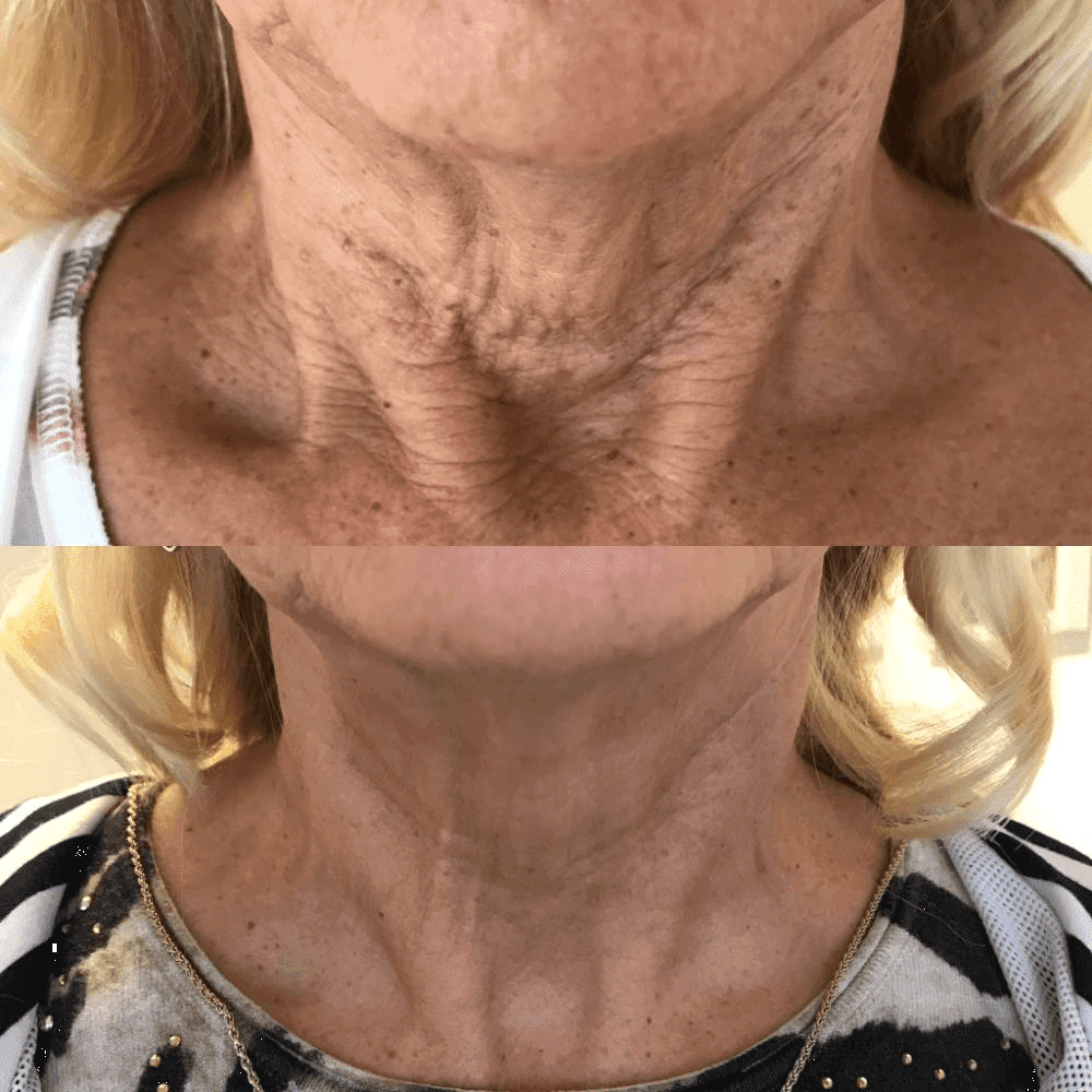 Crepey neck treatment