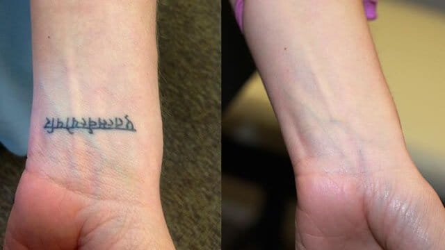 Laser Tattoo Removal Hertfordshire London BeauSynergy