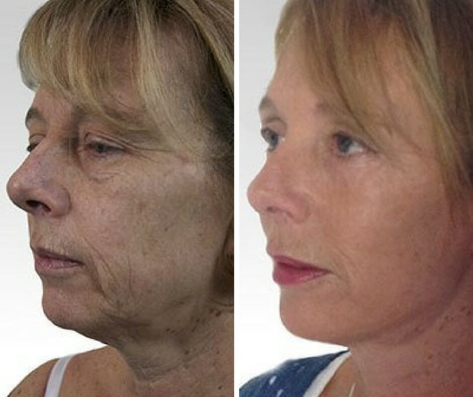 non surgical jowl lift