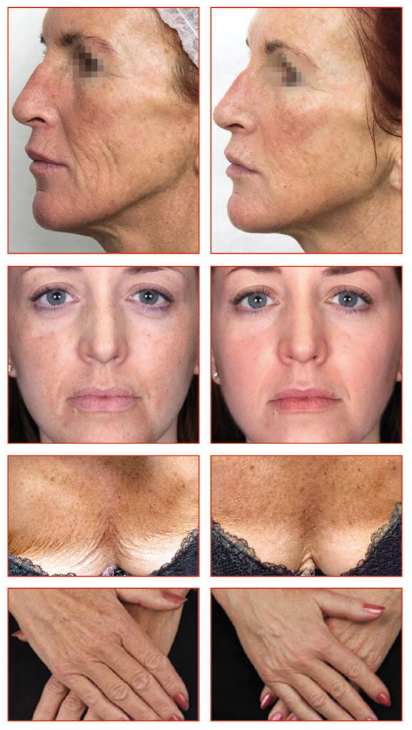 PRX t 33 before and afters