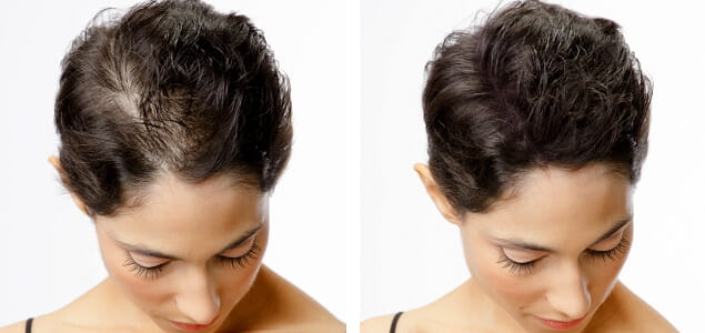 Scalp Micropigmentation women