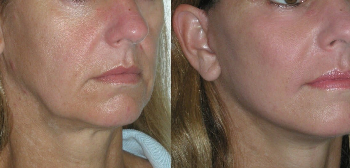non surgical jowl lift