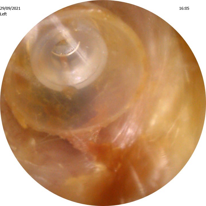 hearing aid dome wedged in ear canal
