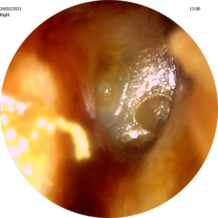 GP Referral ear wax