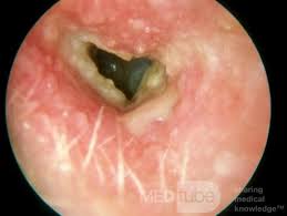 Infected Ear