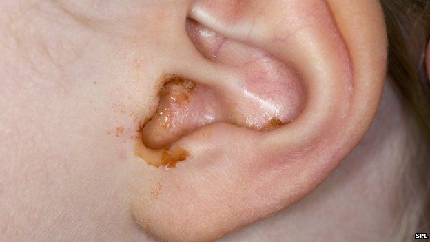 Ear with Wax leaking