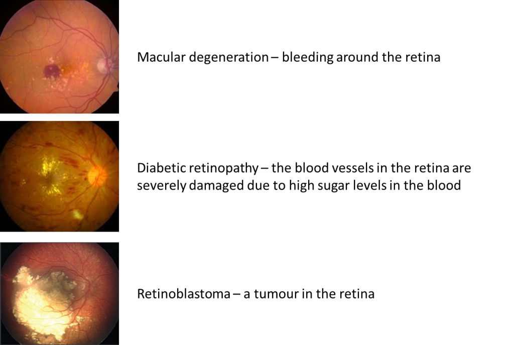 Retina scan with disease