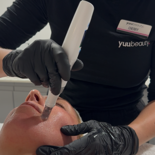 Dermapen™ Face & Neck Microneedling + Peel + PDRN – Save £80