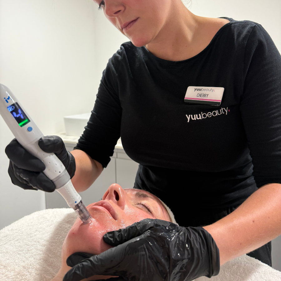 SAVE £80 ON MICRONEEDLING WITH PEEL & PDRN