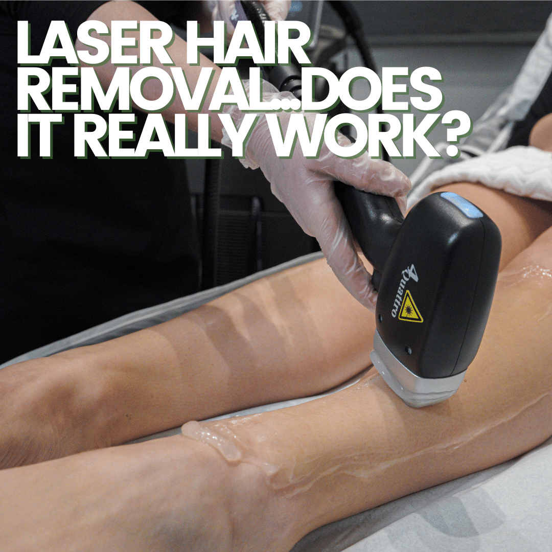 soprano-titanium-laser-hair-removal