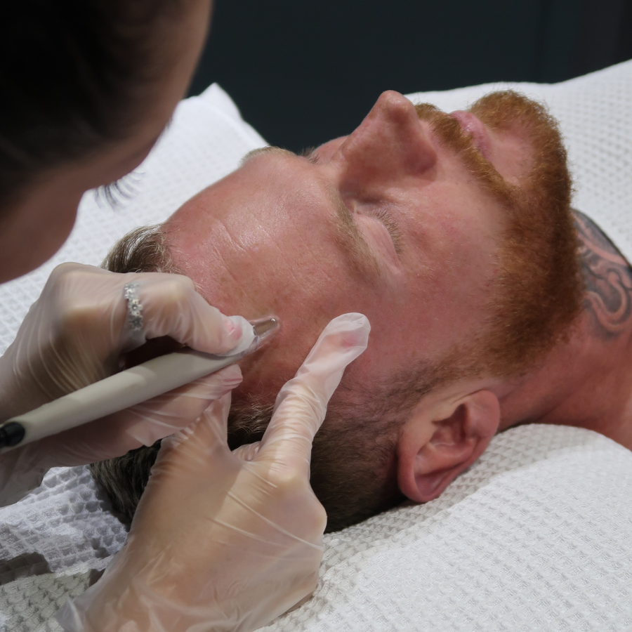 Men's Medical Microdermabrasion