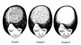 'Female Androgenetic Alopecia - Grading Scale Diagram