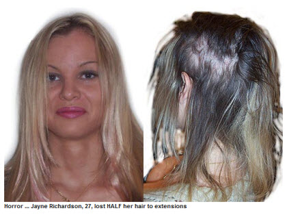 Jayne Richardson - how Mark Glenn cosmetically repaired the damage after she lost half her hair to human hair extensions
