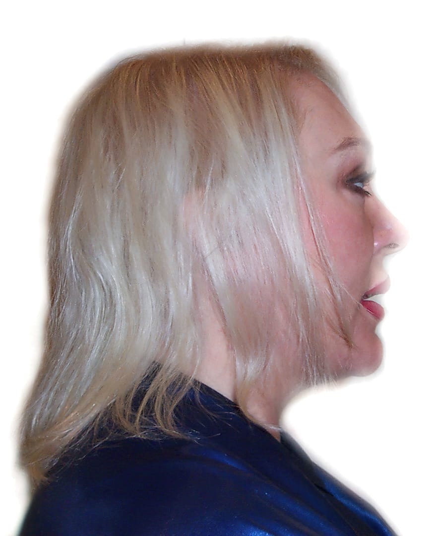 Before Picture - Subtle Body Boost and Thickening