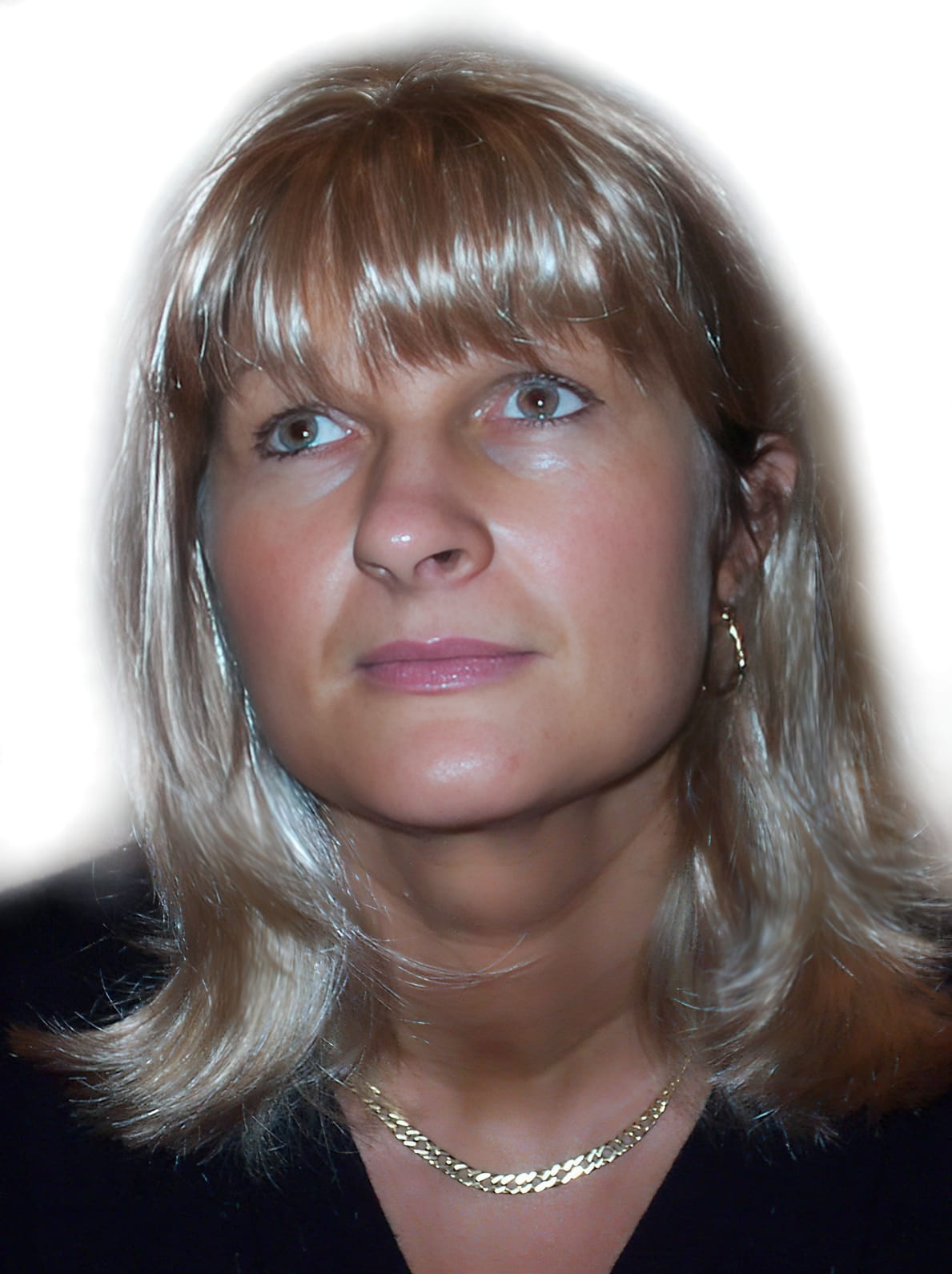 After Picture - Androgenetic Alopecia