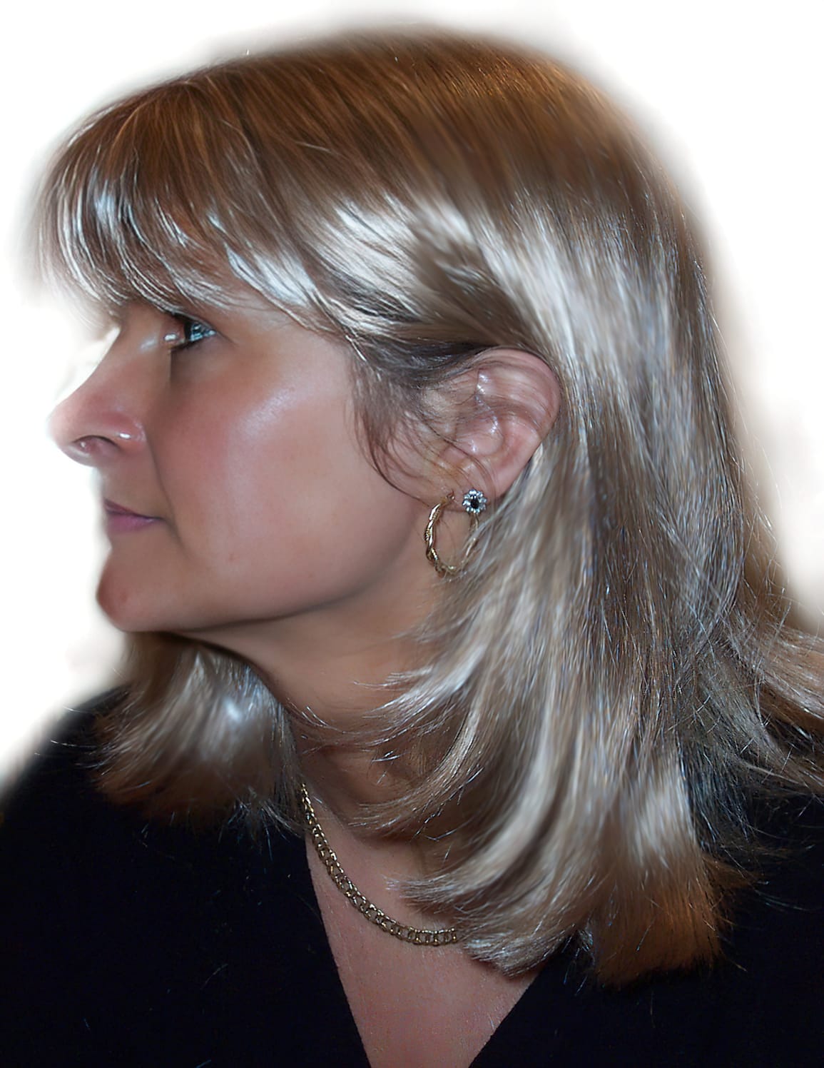 After Picture - Androgenetic Alopecia