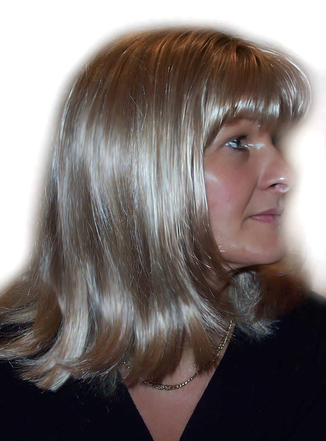 After Picture - Androgenetic Alopecia