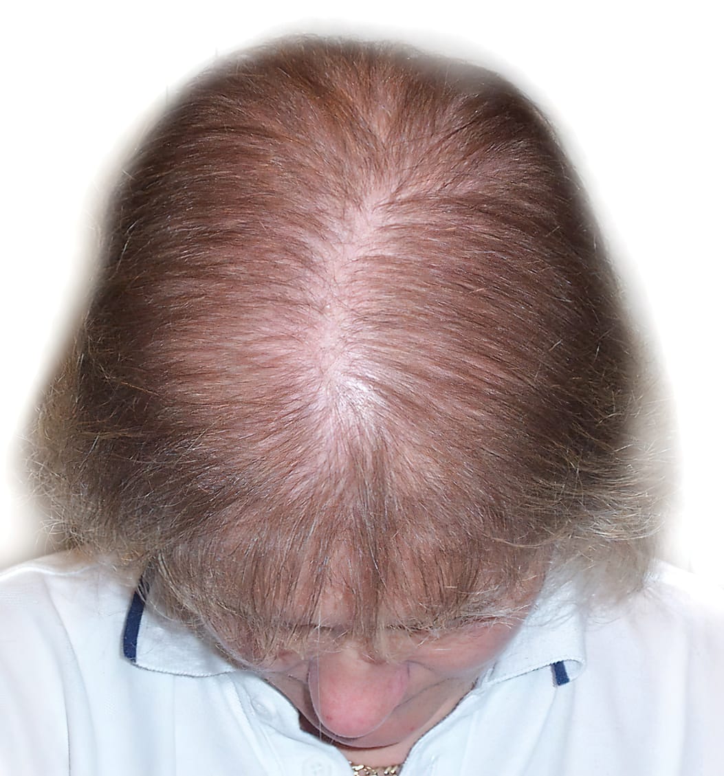 Before Picture - Androgenetic Alopecia