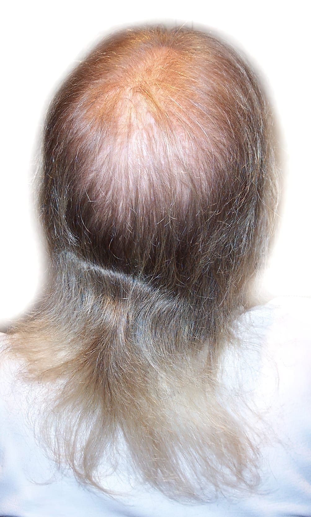 Before Picture - Androgenetic Alopecia