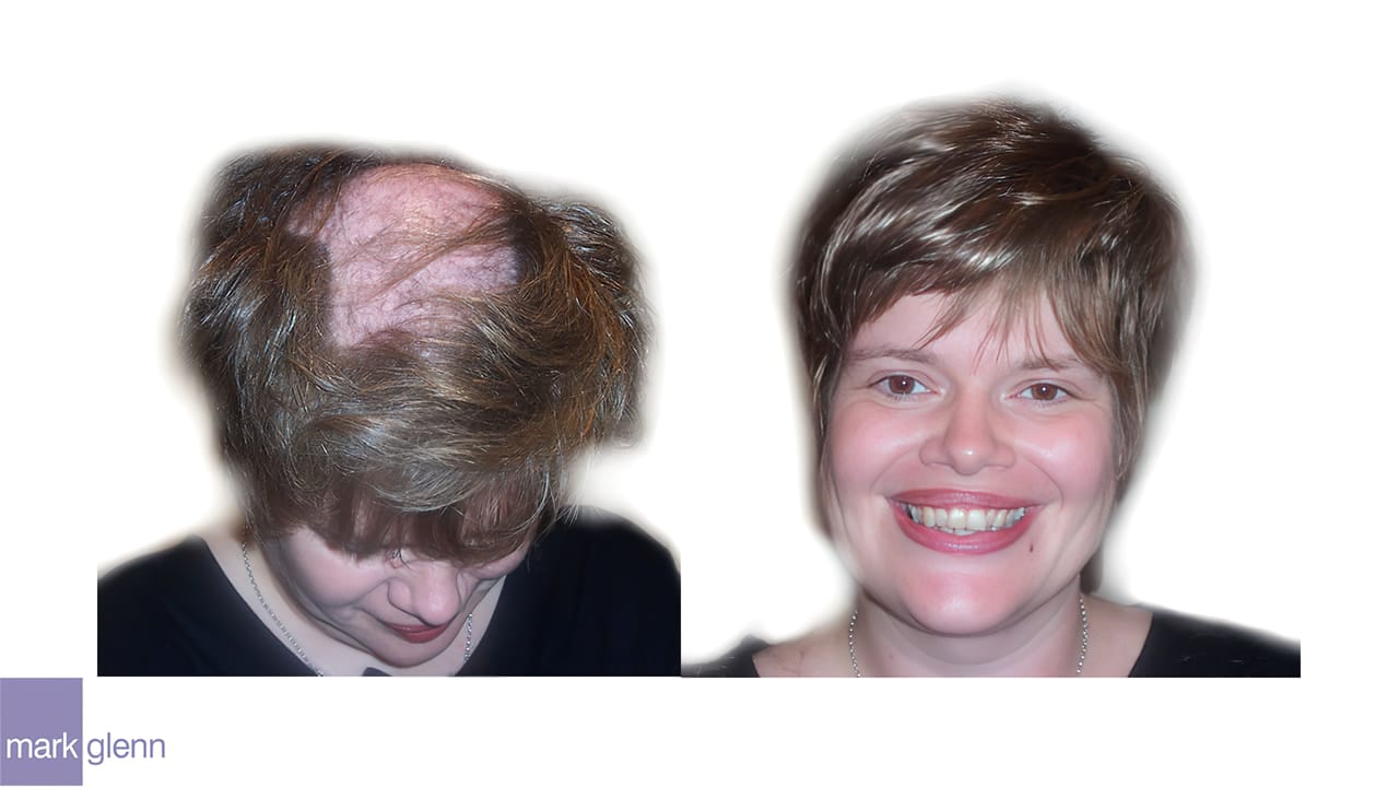 HL003 - Trichotillomania Solution Hair Extensions - London, UK