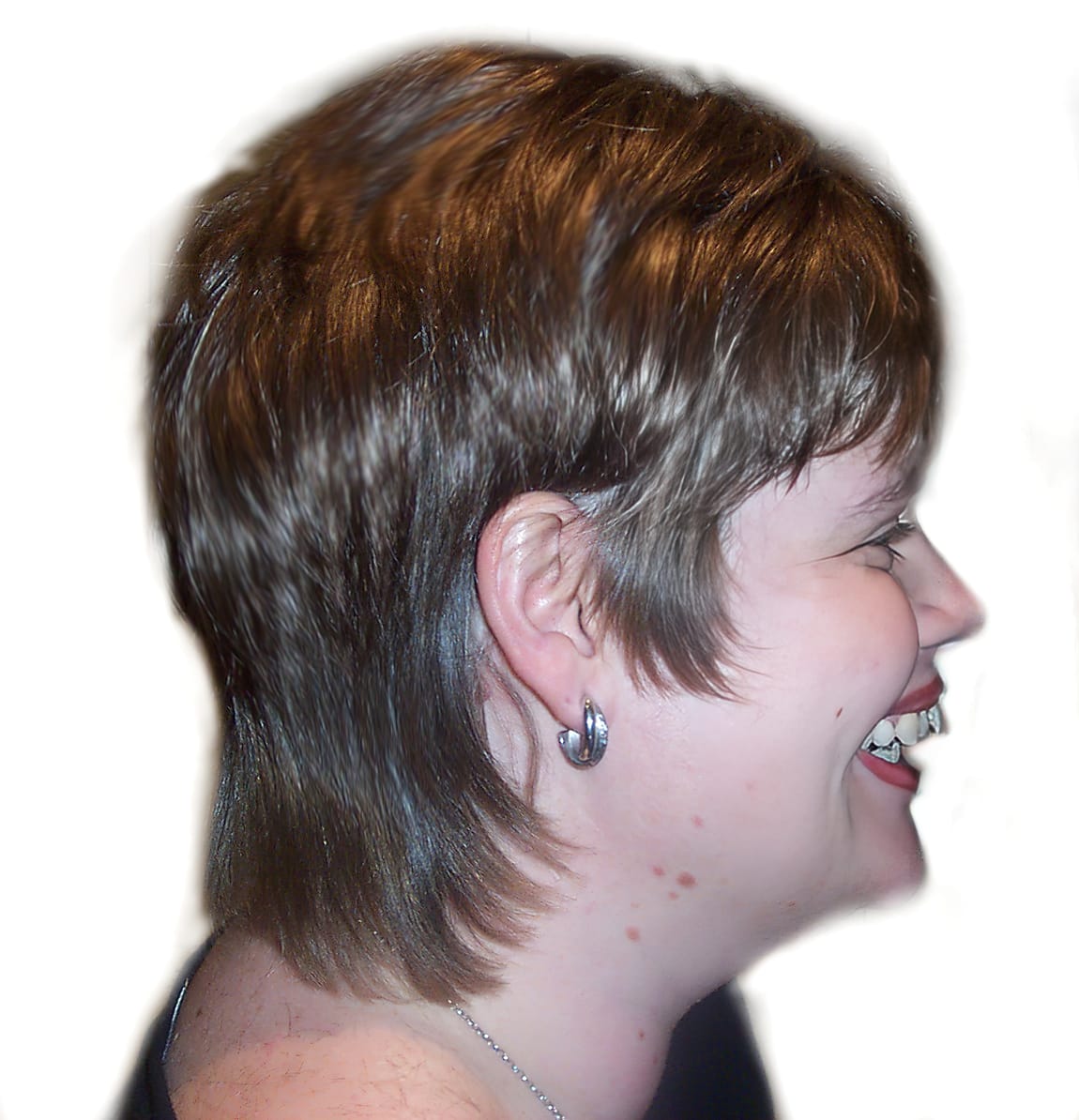 After Picture - Trichotillomania & Full Recovery