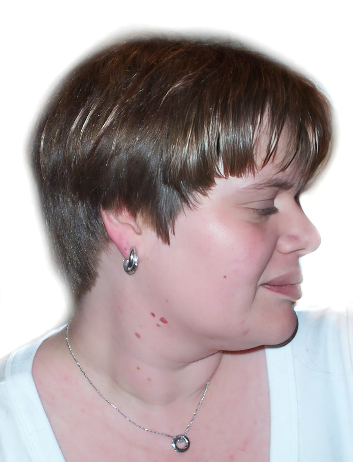 After Picture - Trichotillomania & Full Recovery