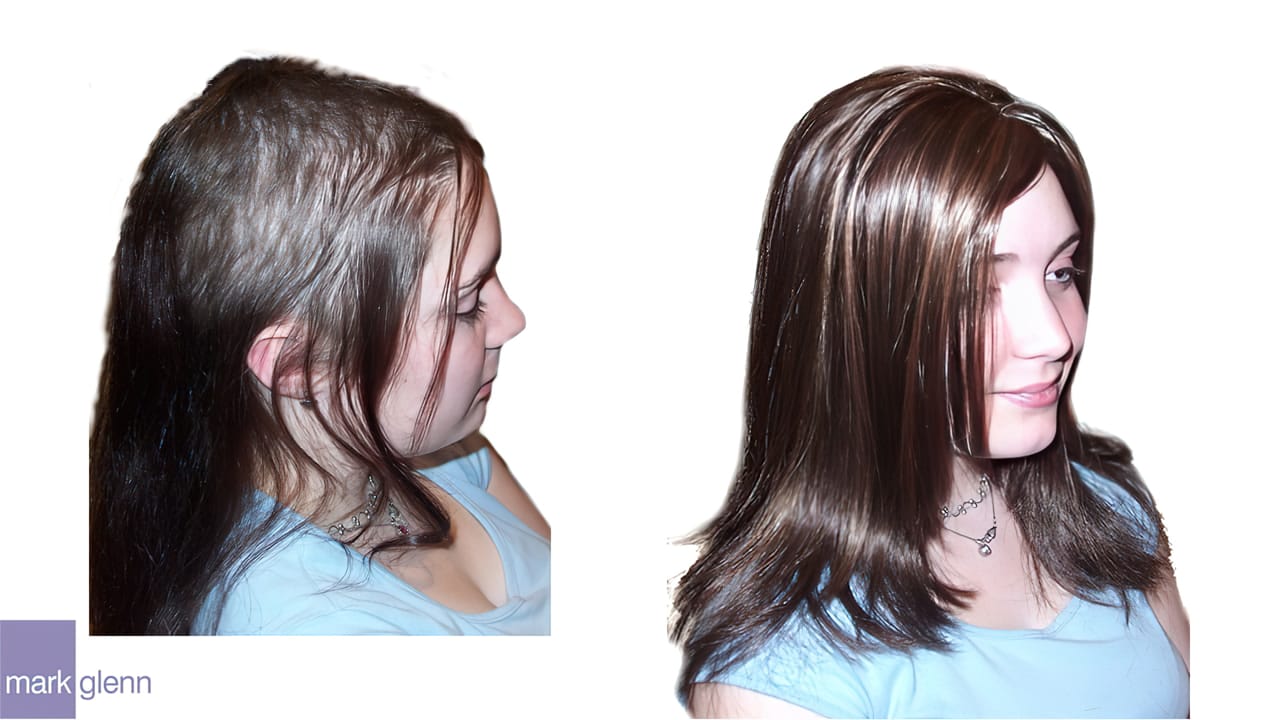 HL005 - Trichotillomania Hair Pulling Kinsey System London UK