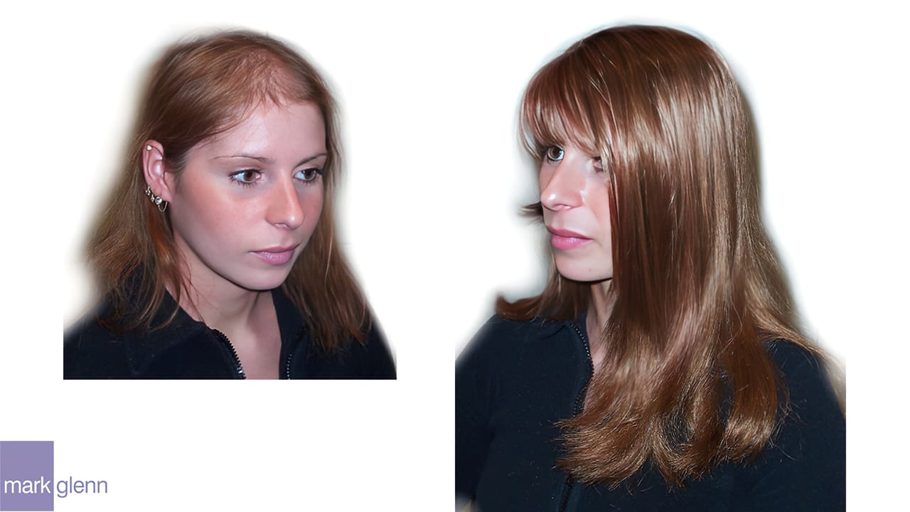 Androgenetic Alopecia Cosmetic Cover-Up