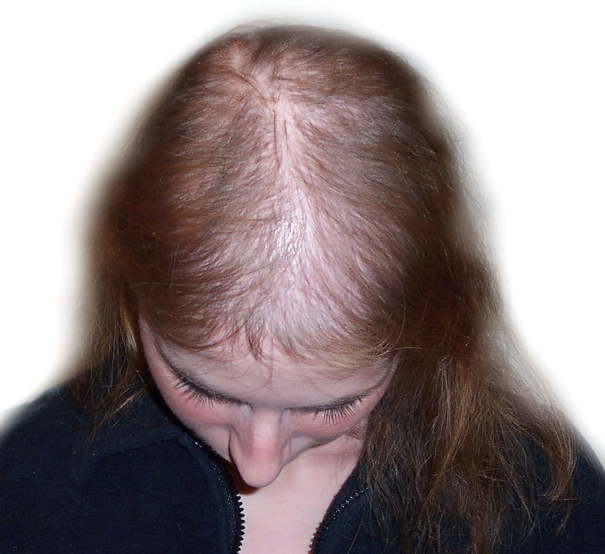 Before Picture - Androgenetic Alopecia or Female Pattern Hair Loss