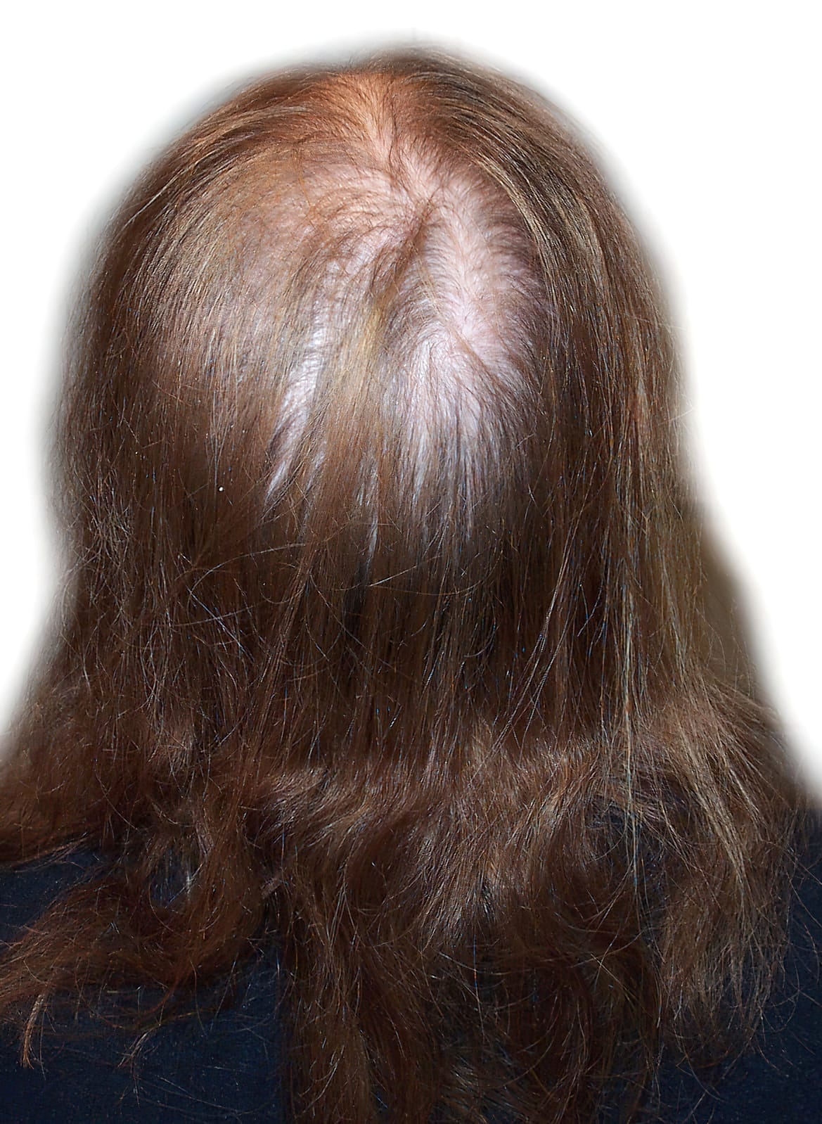 Before Picture - Androgenetic Alopecia or Female Pattern Hair Loss