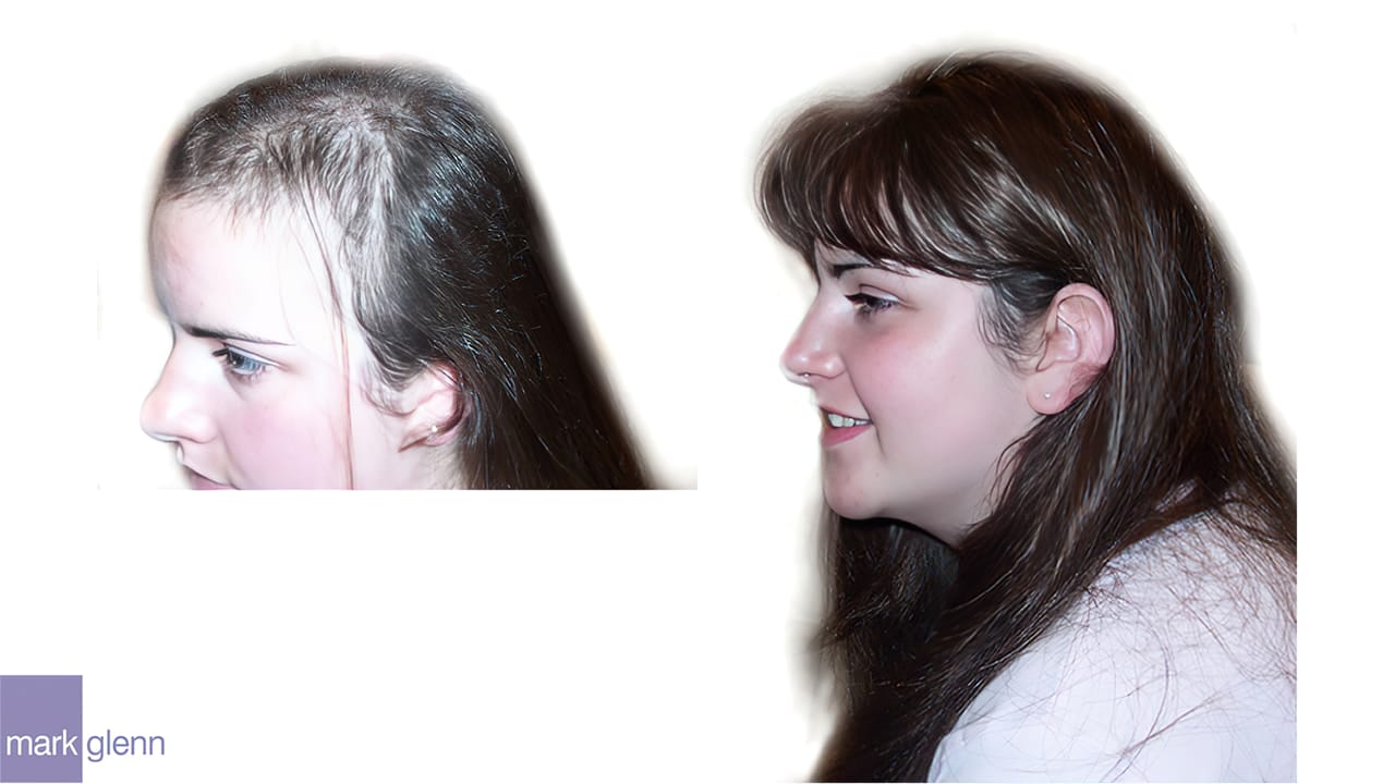 HL011 - Trichotillomania Hair Pulling Turnaround - Cosmetic Solution - London, UK